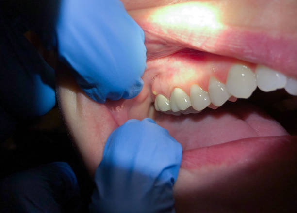 Emergency Gum Pain Relief in OH